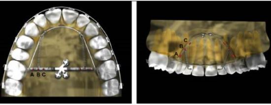 서울성모병원 치과교정과 국윤아 교수팀이 개발한 돌출입 교정장치 mcpp를 입천장에 장착한 모습 이기수 기자
