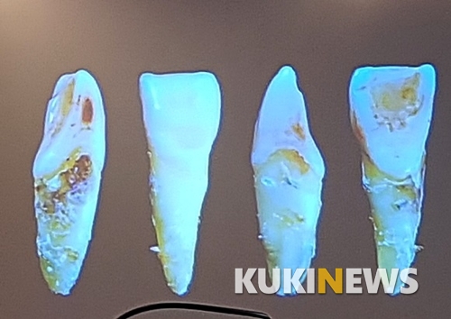 잇몸질환으로 빠진 치아가 굉장히 불량한 상태임을 보여주고 있다.